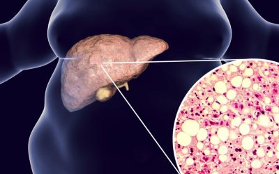 Síndrome Metabólica: é melhor prevenir do que ter de medicar